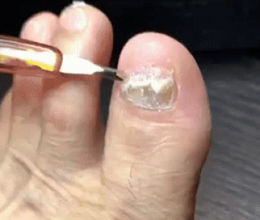 Plasturi unghii cu ciuperci